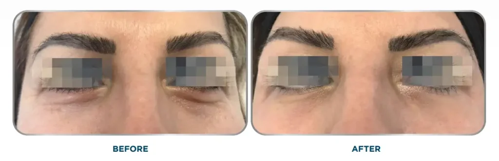 A patient's before and after photo of their Sunekos treatment for their dark circles and eyebags.