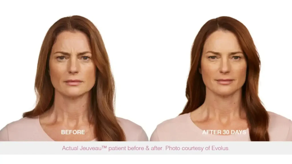 A patient's before and after photo of their Jeuveau's facial injection.