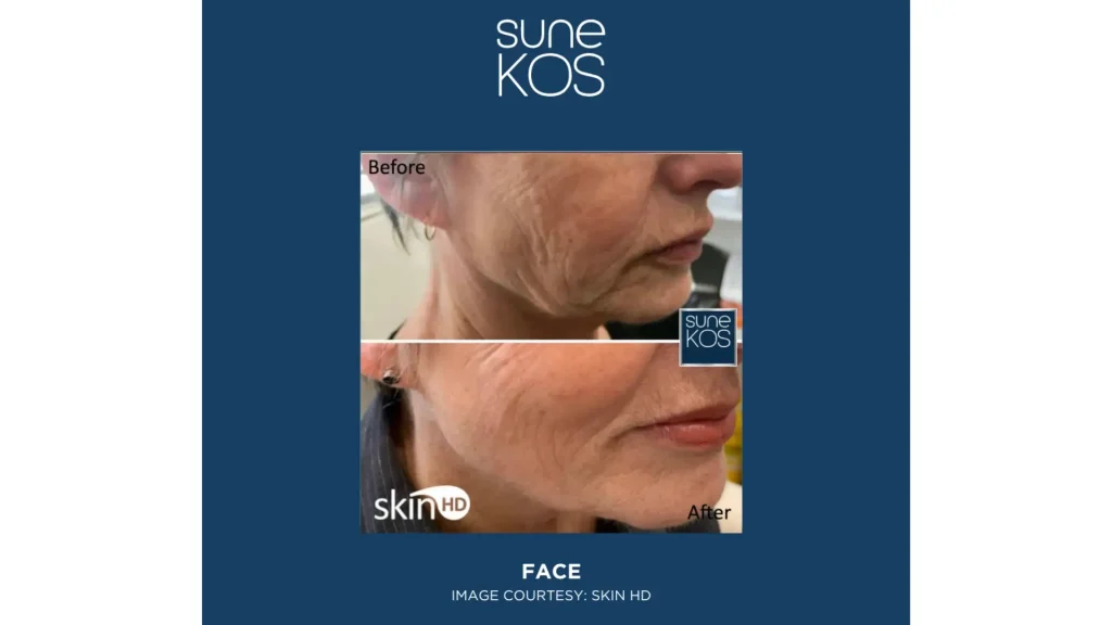 An older individual's mid-face area and improved skin texture.
