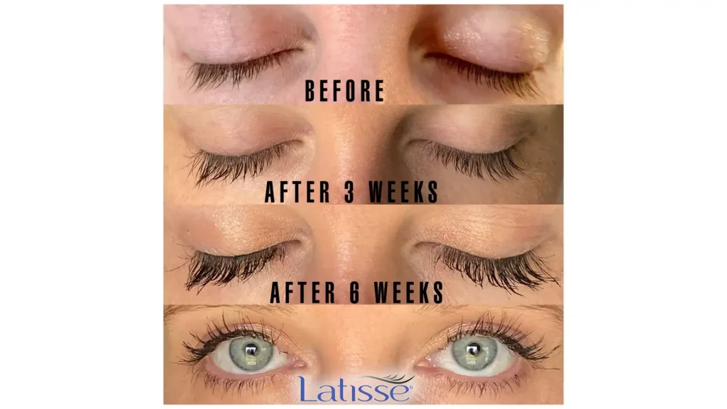 A Latisse-treated patient's before and after photo of their prominent lashes.