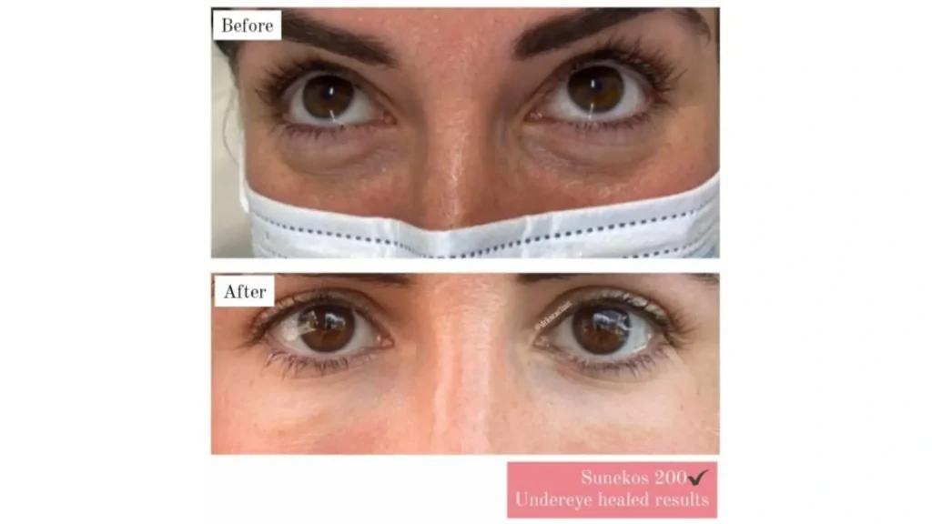 A patient's before and after photo of their Sunekos 200 treatment.