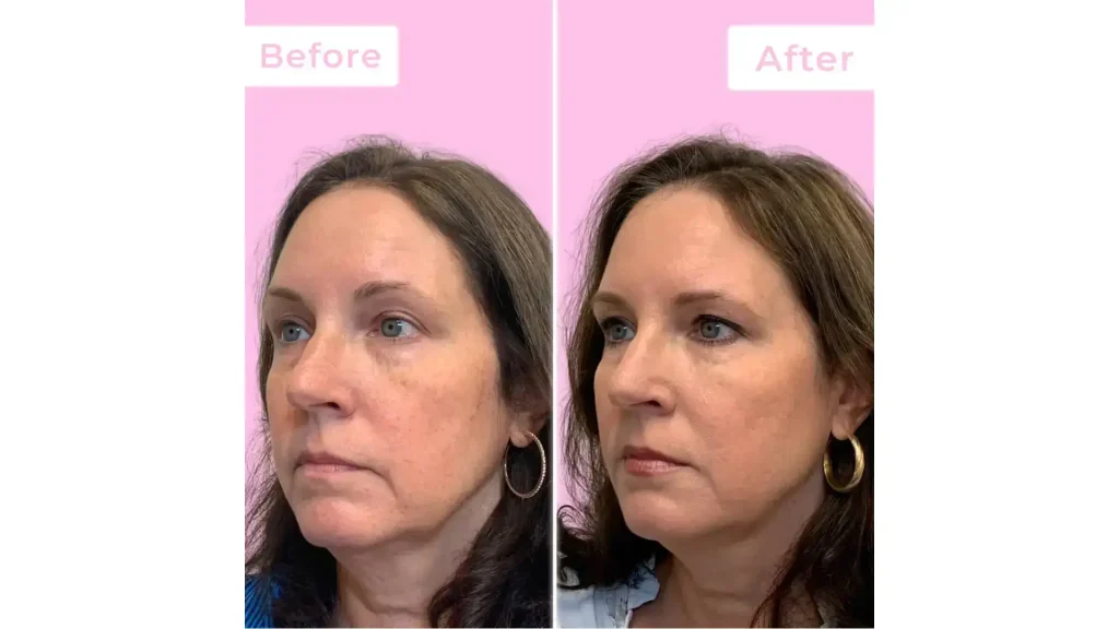 An individual's before and after photos of their Jeuveau treatment.