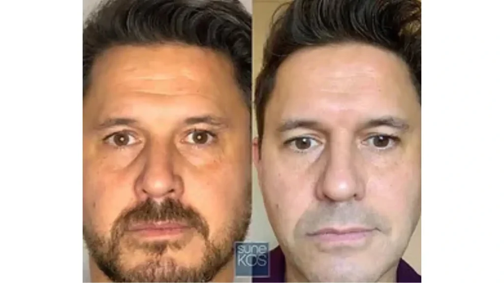 An individual's before and after photo with improved skin firmness.