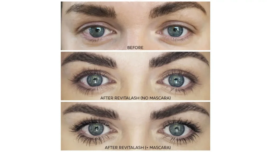 A Revitalash-treated patient's before and after photo of their eyelashes.