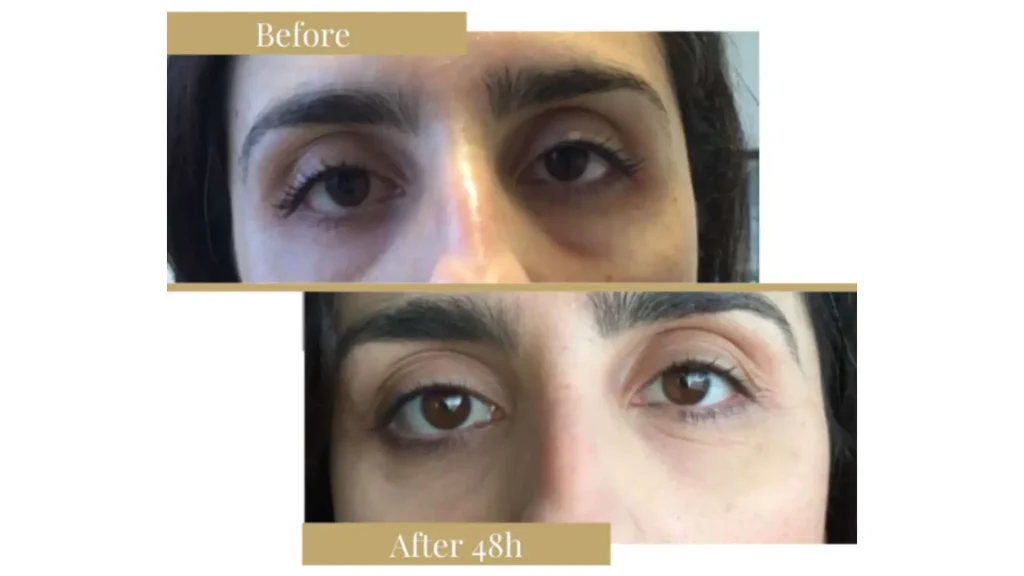 A patient's before and after photos of their Sunekos injection treatment.