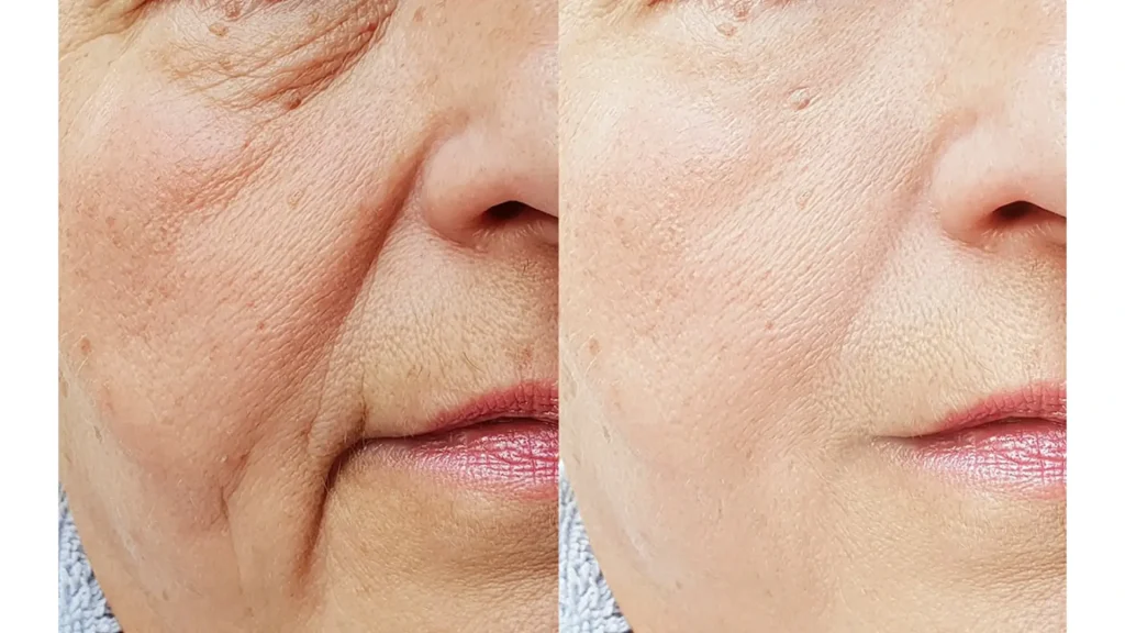 An individual's firmer skin and less wrinkles in their mid-face after their Sunekos treatment.