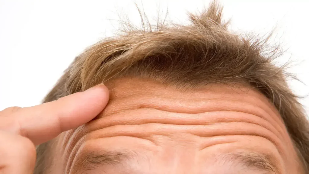 A close-up shot of horizontal forehead lines.