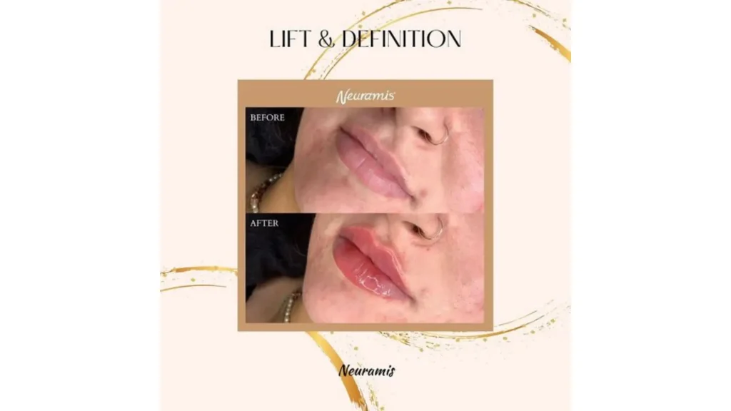 A Neuramis-treated patient's before and after photo of their lip enhancement.