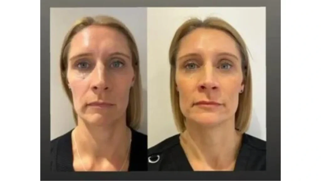 A patient's before and after photo of their Harmonyca treatment.