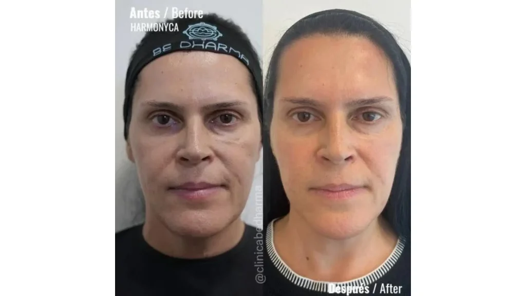 An individual who had undergone Harmonyca treatment.