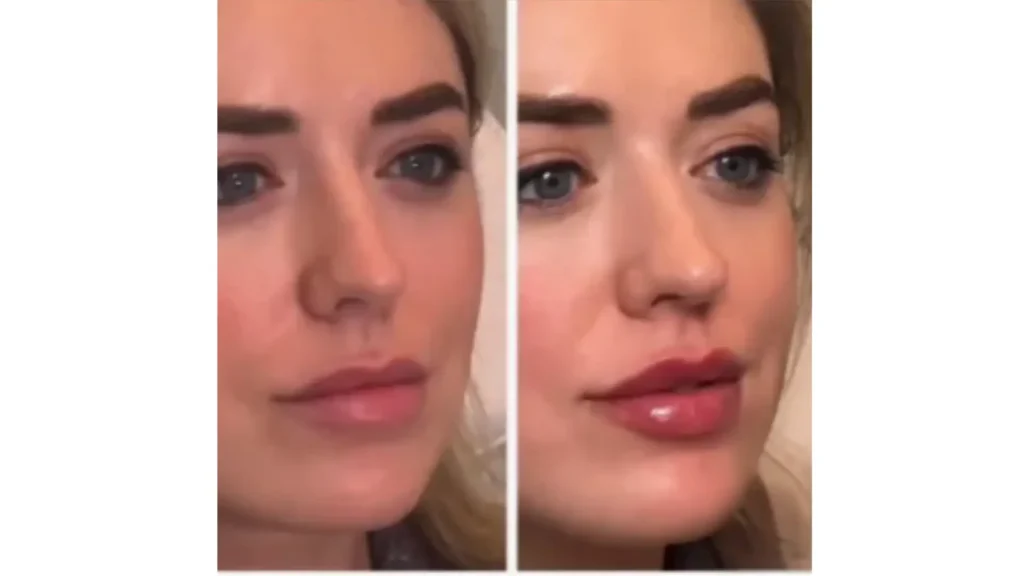 A Neuramis-treated patient's before and after photo of their lip filler.