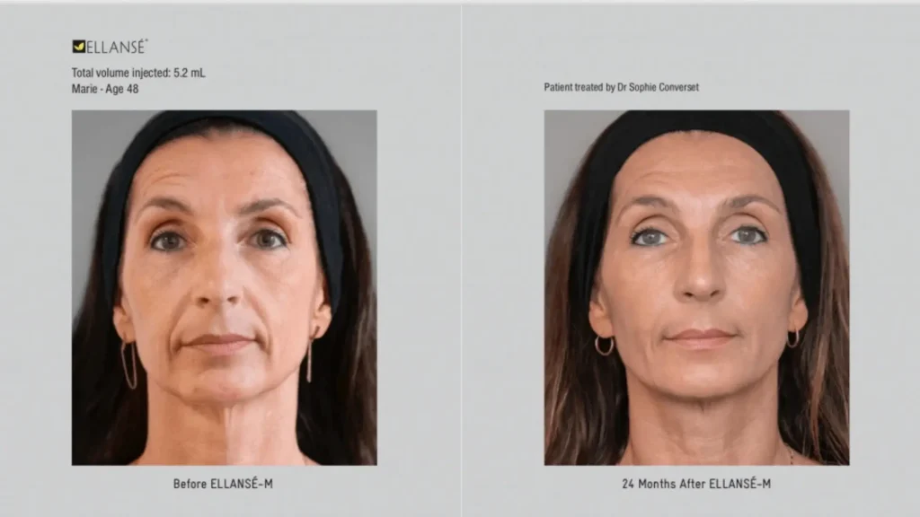 An Ellanse-treated patient's before and after photo of their full-face rejuvenation, including their forehead lines.