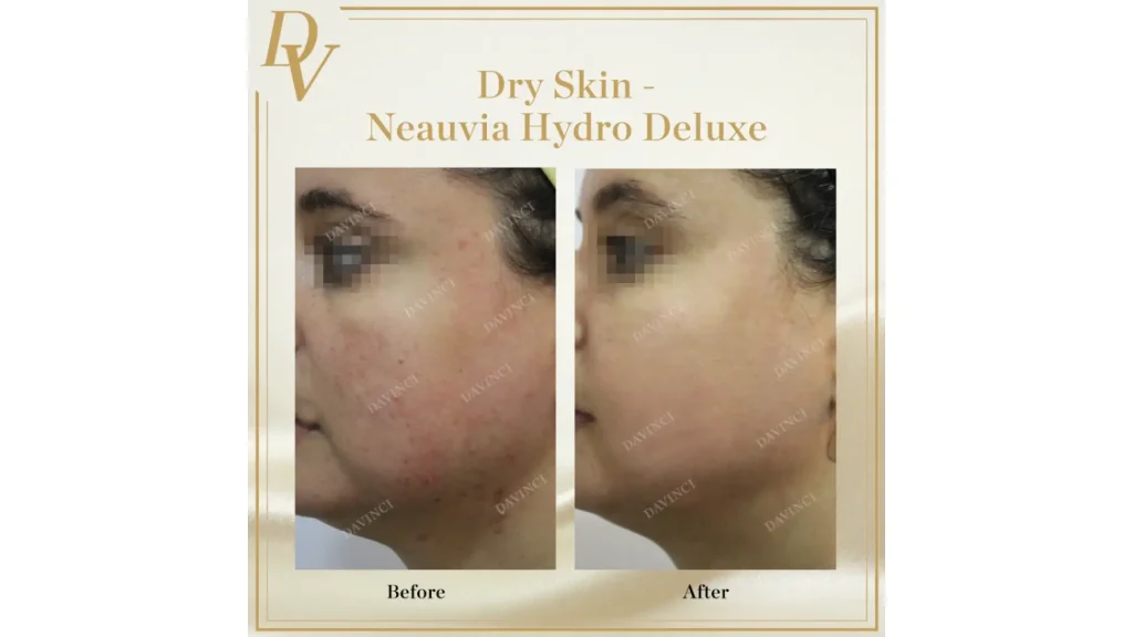 A Neauvia Hydro Deluxe patient's before and after photo of their cheek treatment.