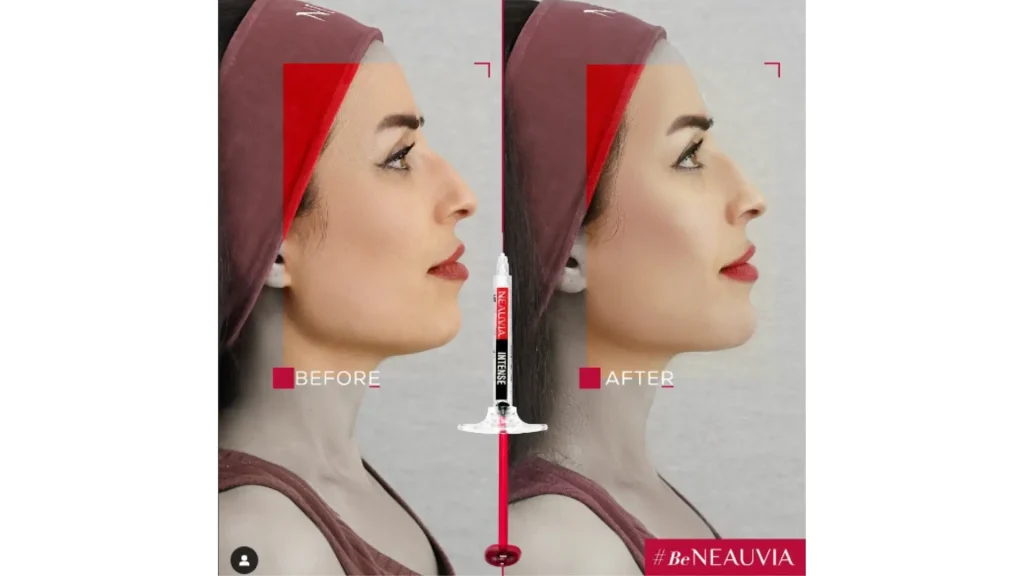 A patient's before and after photo of their Neauvia facial treatment.