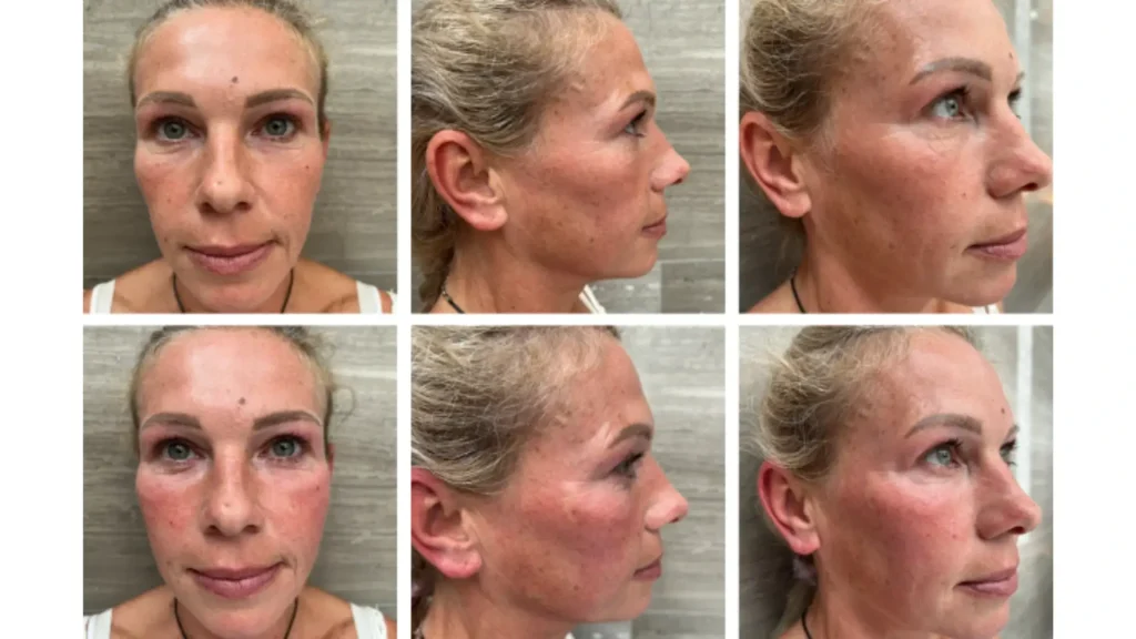 A Nucleofill-treated patient's before and after photos with their two facial treatments.