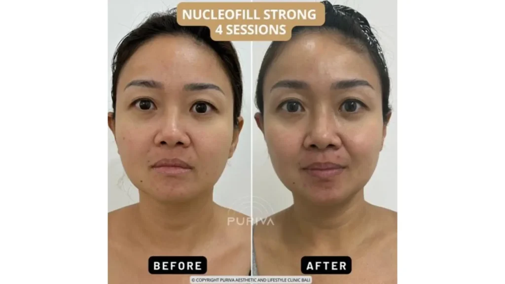 A Nucleofill-treated patient's before and after photo of their full-face rejuvenation.