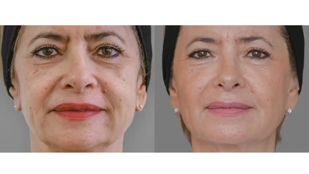 An Ellanse patient's before and after photo of the filler's two-year improvements.