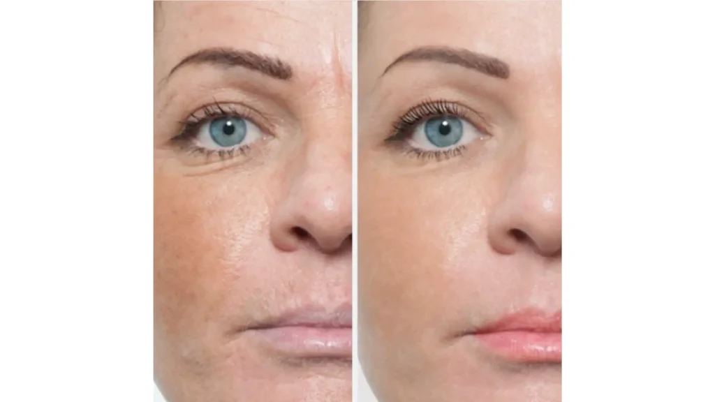 A patient's before and after photo of their facial transformation with Neauvia treatment.