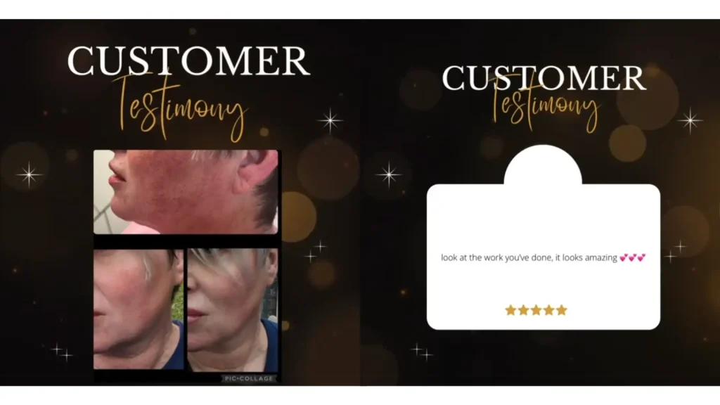 A patient shared their experience with Nucleofill treatment, showing its efficacy in addressing their jawline and jowls areas.