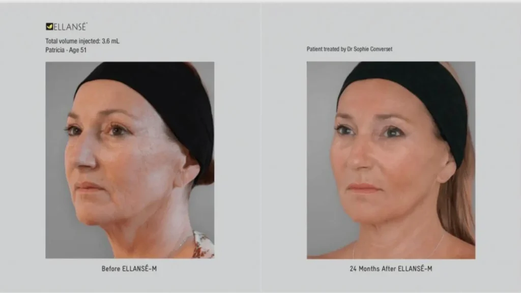 An individual's Ellanse before and after photos of their facial enhancements in a year.