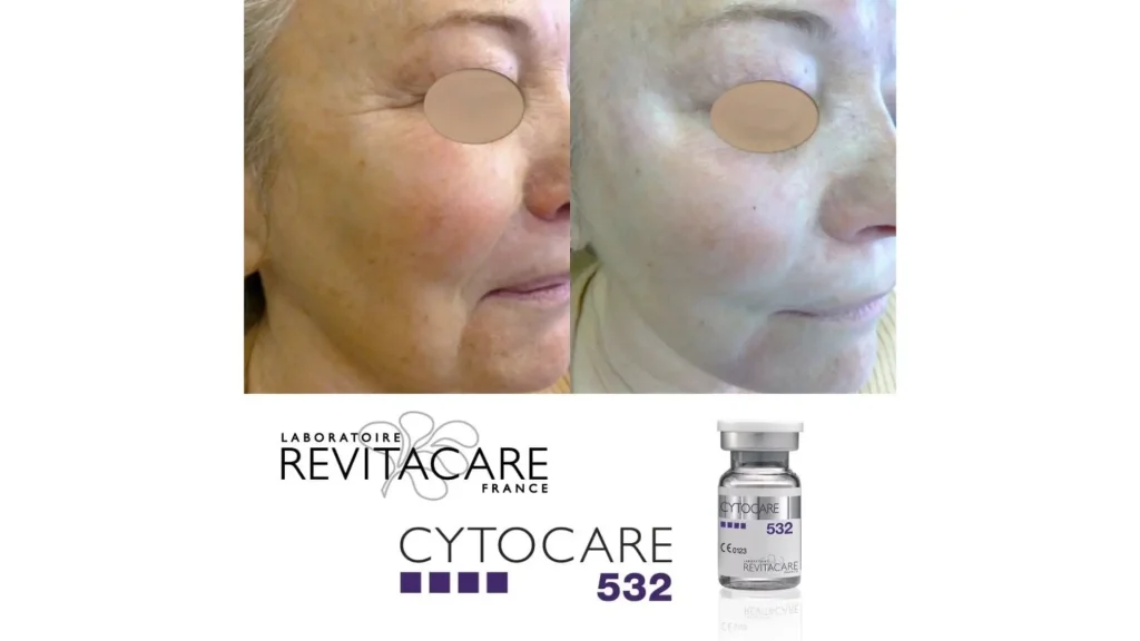 An older patient addressed their facial aging signs with Cytocare 532 and achieved a revitalized midface area.