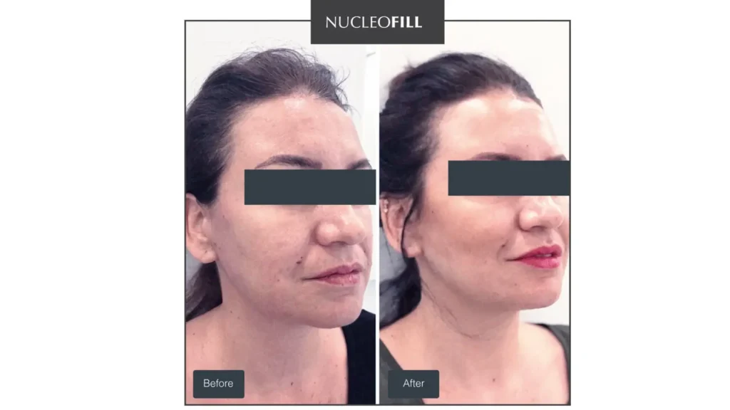 A Nucleofill-treated patient's before and after photo of their facial rejuvenation.