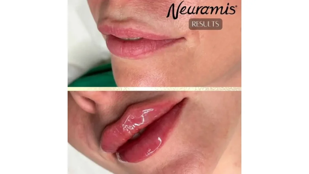 A patient's before and after of their Neuramis filler for lips treatment.