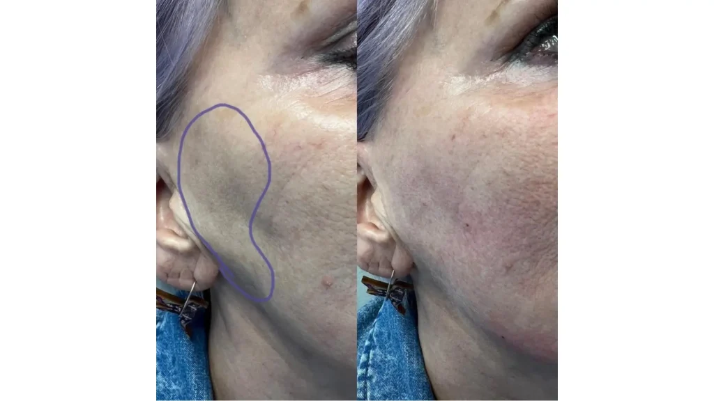 A close-up shot of a Harmonyca before and after photo of a treated patient on their mid-face.