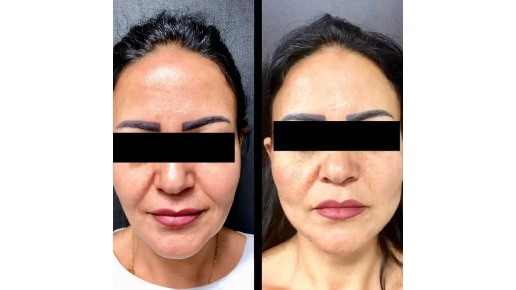 A Nucleofill's improved facial appearance from facial aging signs after their treatment.