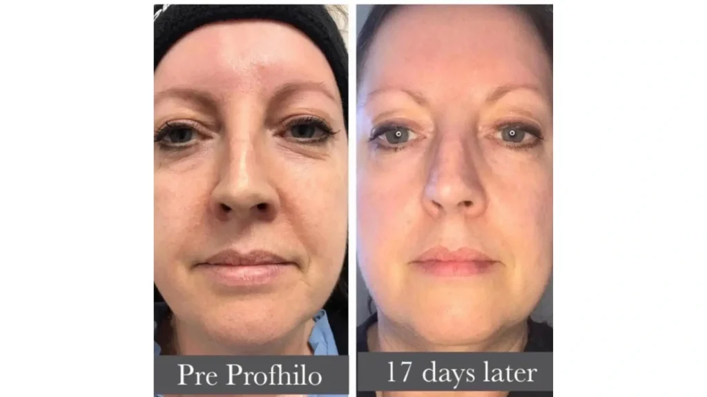 A Profhilo-treated patient's before and after photo of their facial injection treatment.