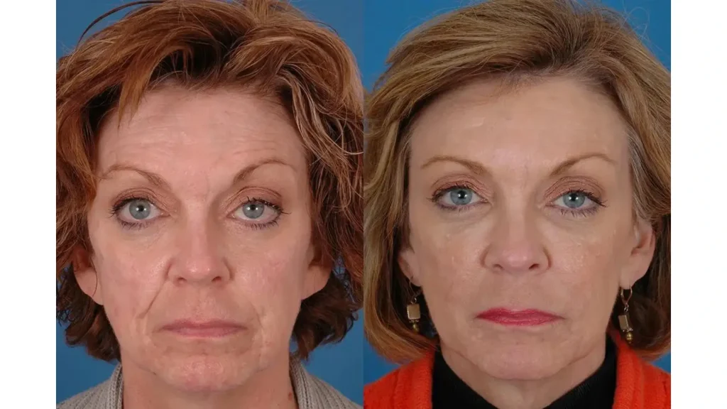 An older individual's before and after photo of their Sculptra treatment.