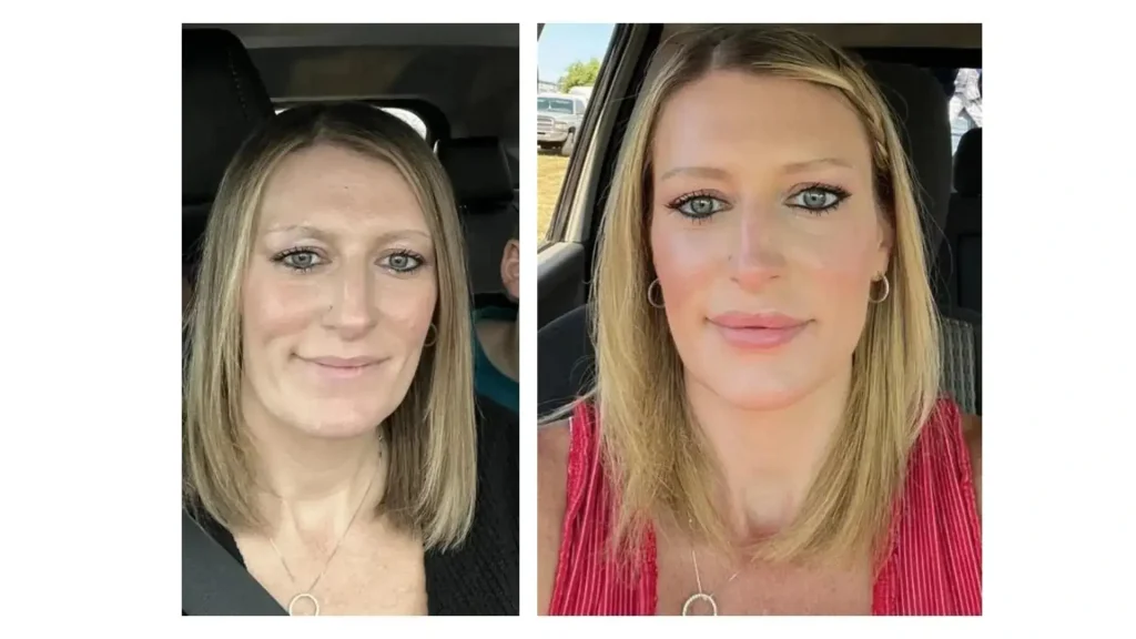 A Juvederm-treated patient's before and after photo of their lip filler procedure.