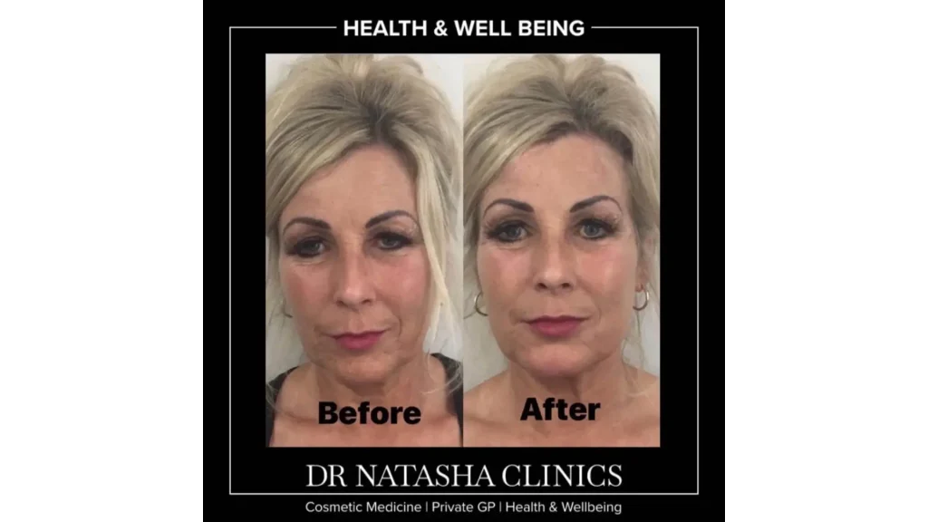 A patient's Ellanse before and after photo that has also addressed their forehead lines and wrinkles for a smoother look.