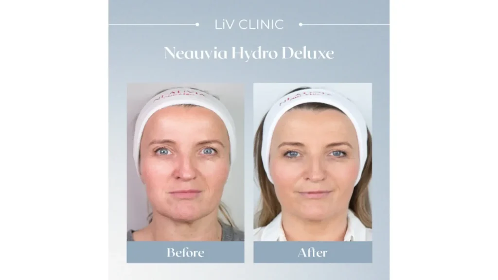 A patient's before and after photo of their Neauvia Hydro Deluxe aesthetic treatment.