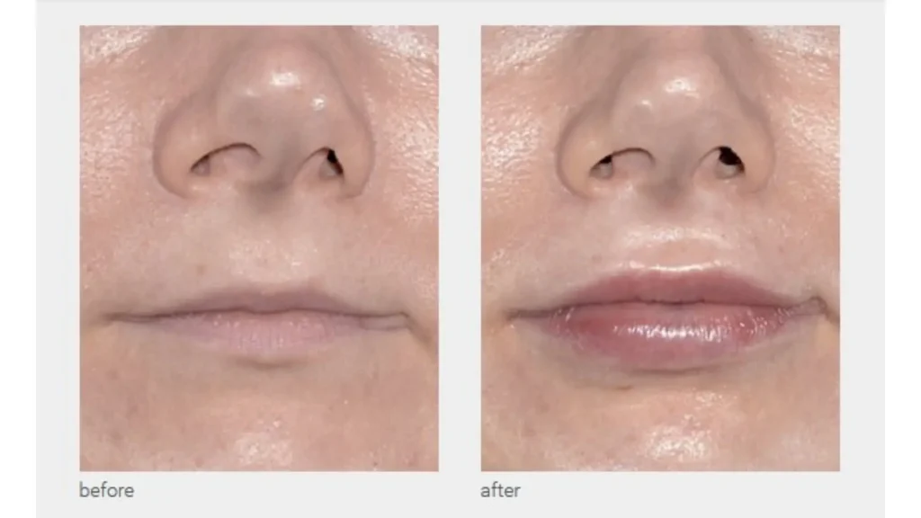 A patient received Neauvia for their lip augmentation and achieved transformative outcomes.
