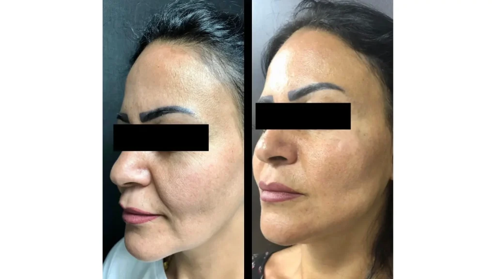 A Nucleofill before and after photo of a patient's improved and rejuvenated cheeks.
