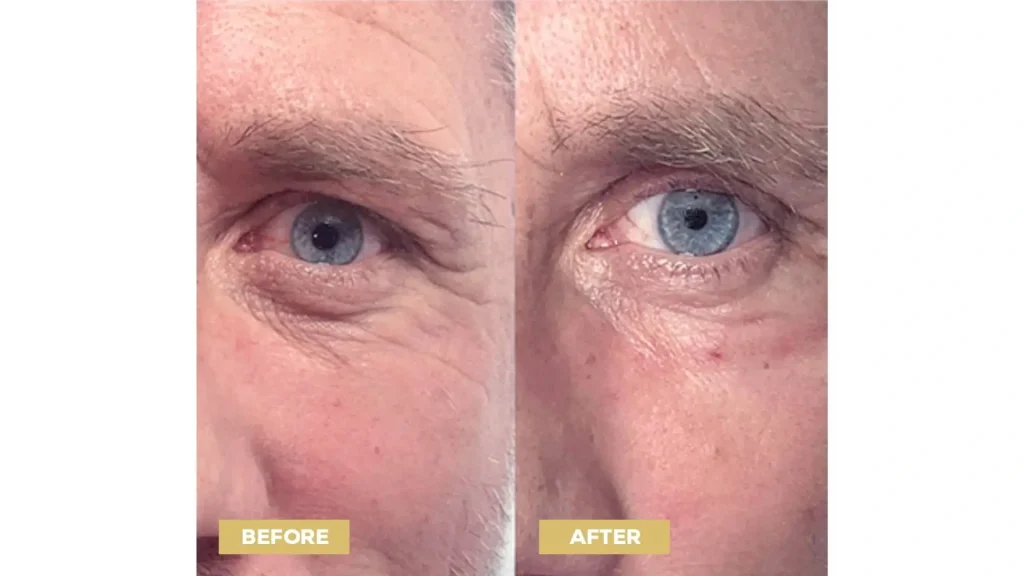 A close-up shot of a patient's Nucleofill before and after photo of their rejuvenated under eye region.