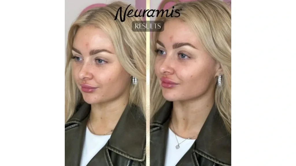 A Neuramis-treated patient's before and after photo of their lip enhancement.