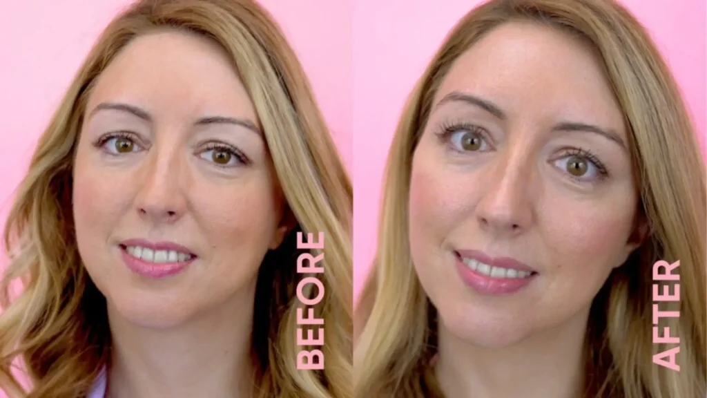 A Profhilo-treated patient showing off the skin rejuvenation provided by the skin booster.