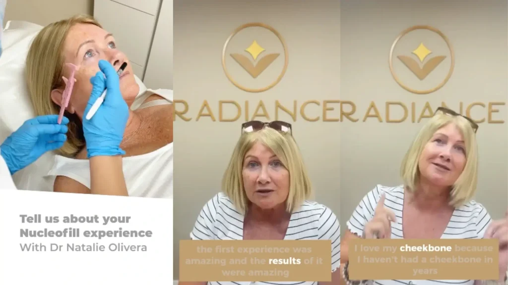 A patient sharing their enthusiastic experience with Nucleofill injections into their cheekbones.