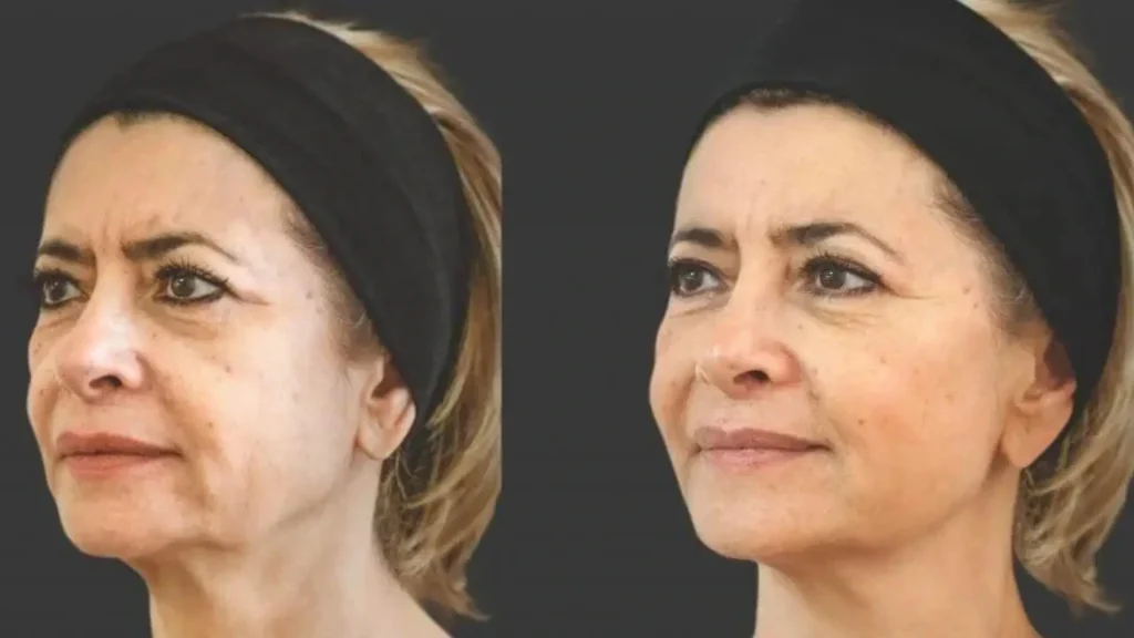 A patient's Ellanse before and after photos of their injectable facial treatment.