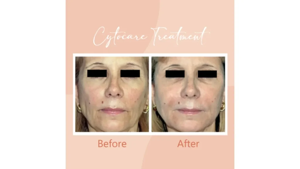 A patient received Cytocare for their midface region, showing the revitalized skin after treatment.