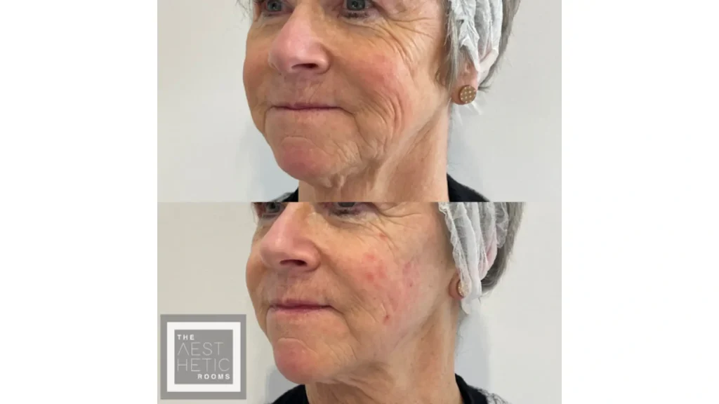 An older individual's improved nasolabial folds after their Harmonyca filler treatment.