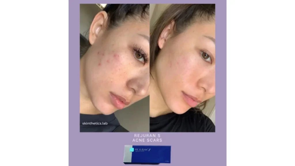 A Rejuran-treated patient's before and after photo of their facial acne enhancement.