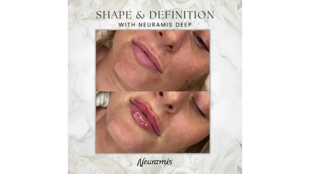 This patient's Neuramis filler for lips treatment shows the impressive improvements of their pout in shape and contour.