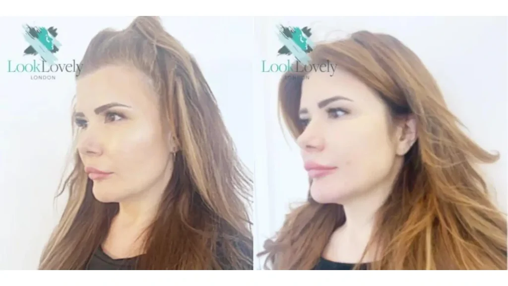 A patient's before and after photo of their Harmonyca filler enhancement on their cheek area.