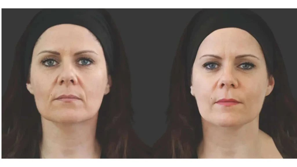 This patient addressed their facial wrinkles and folds with Ellanse dermal filler, including '11' lines, under-eye region, and nasolabial folds.