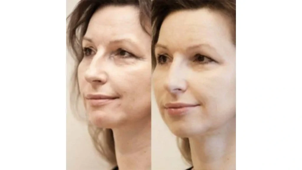A patient's before and after photo of their Neauvia facial injection treatment.