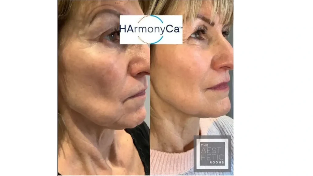 A patient's before and after photo of their Harmonyca treatment, highlighting its effectiveness in the cheek area.