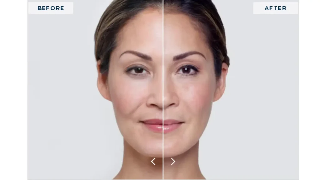 A Restylane-treated patient's before and after photo of their nasolabial fold and cheeks enhancements.